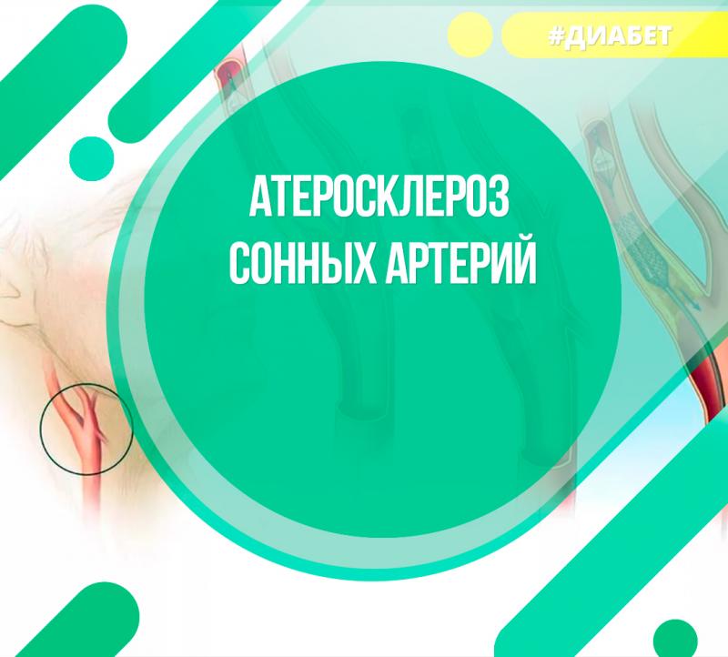 Атерасклероз сонных артерий